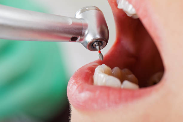 Best Emergency Wisdom Teeth Removal in Des C, AR